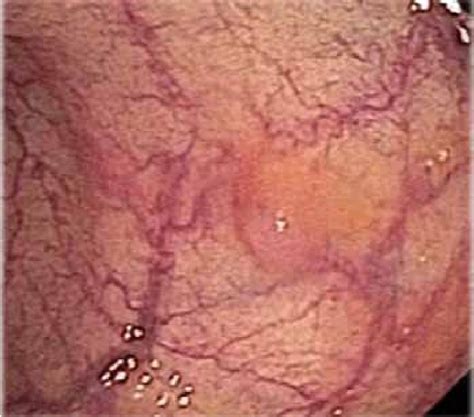 Endoscopy view of ganglioneuroma. | Download Scientific Diagram