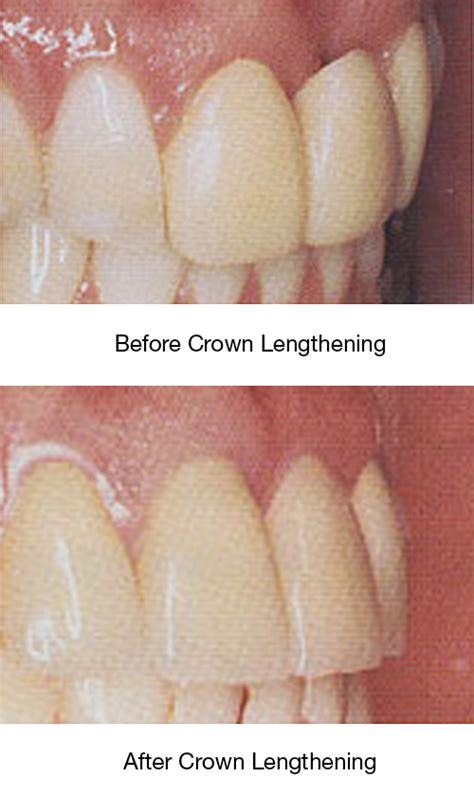 Ridge Augmentation – Altschuler