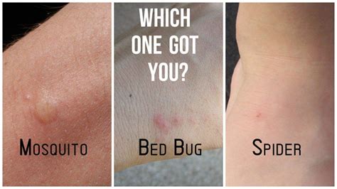 Mosquito Bite Bed Bug Bite Difference