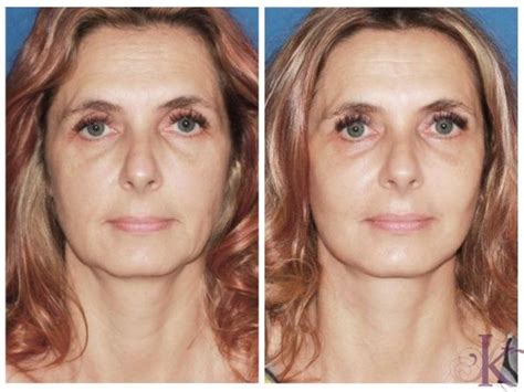 Mini Facelift Before and After Photo Gallery | NYC New York, NY | Konstantin Vasyukevich, MD