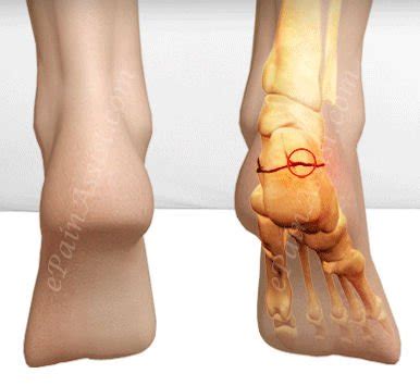 Calcaneal Fracture Treatment - Exercises, FAQs, Case