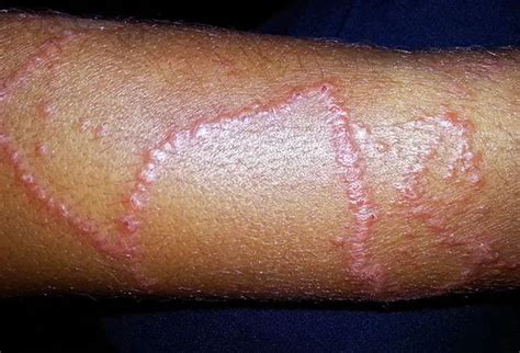 Pictures of Skin Diseases and Problems – Portuguese Man of War Sting