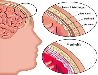 What are Meningitis & Meningococcal - Meningitis Centre