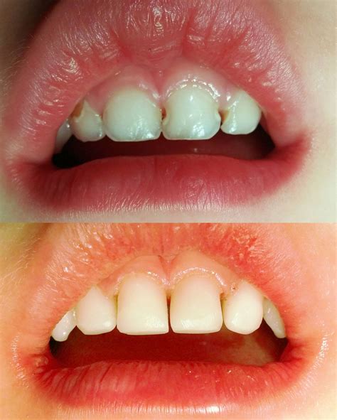 Staining or Cavities on the Front Teeth? | Playtime Dentistry