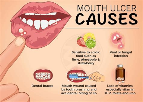 What causes Canker Sores? - Yoors