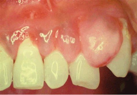 FULL TEXT - Peripheral ossifying fibroma of gingiva: A case report ...