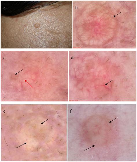 Frontiers | Detection of sebaceous gland hyperplasia with dermoscopy and reflectance confocal ...