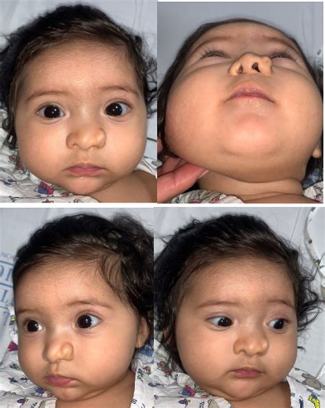 Proboscis Lateralis With Choanal Atresia : Journal of Craniofacial Surgery