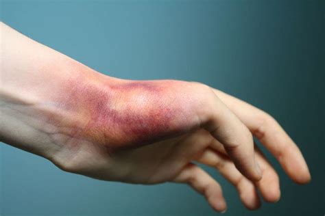 Images Of Sprained Wrist - igewame