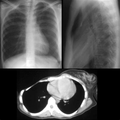 Pediatric Poland Syndrome | Pediatric Radiology Reference Article | Pediatric Imaging | @pedsimaging