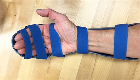 Dorsal Blocking Orthosis For Flexor Tendon Rehabilitation Orfit | My ...