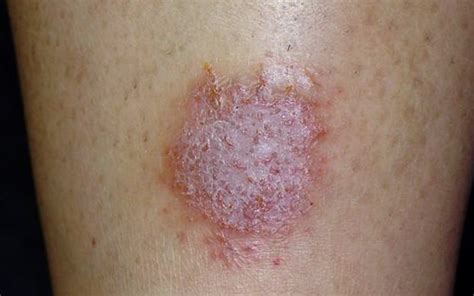 Nummular Eczema - Pictures, Treatment, Causes, Symptoms, Diagnosis - (2018 - Updated)