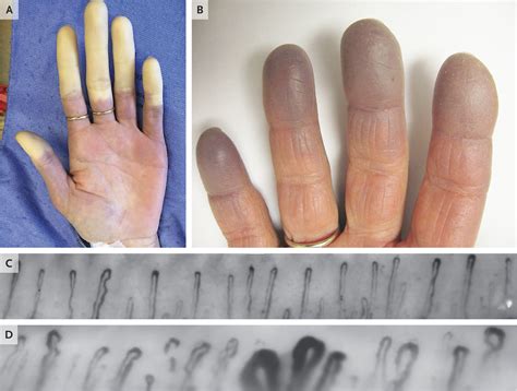 Raynaud’s Phenomenon | NEJM