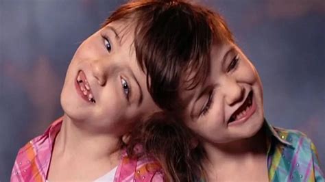 Inspirational tale of conjoined twins who will share sight, taste and ...