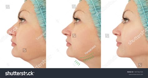 Woman Chin Lift Before After Procedures Stock Photo 1307362720 | Shutterstock