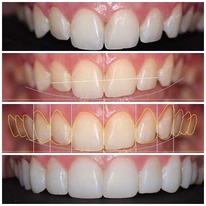 Composite Veneers Before & After