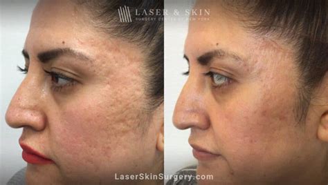 How to Treat Pitted Acne Scars and Boost Your Confidence - Laser NY