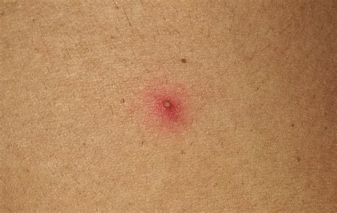 Folliculitis-Folliculitis - Symptoms & causes - Mayo Clinic (2023)