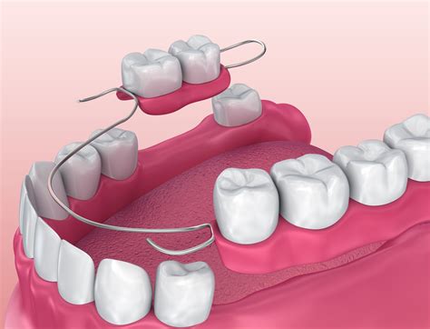 Partial Dentures - Kansas City, MO - John P. Goodman