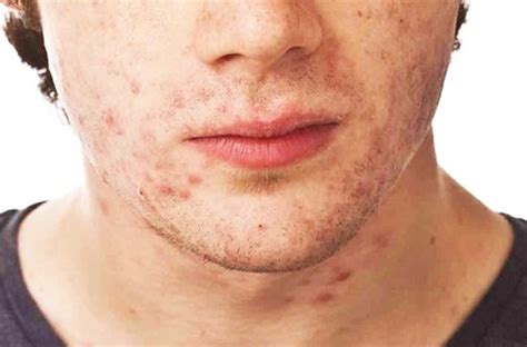 Acne Fulminans: A Severe Form of Acne Mostly Seen in Male Teens ...