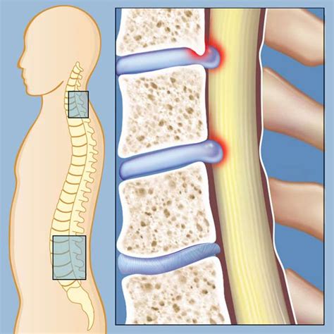 Spinal Stenosis Treatment in Phoenix AZ | Original Health Institute