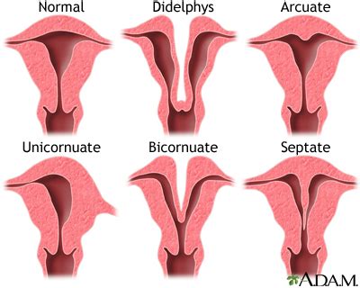 Congenital uterine anomalies: MedlinePlus Medical Encyclopedia Image