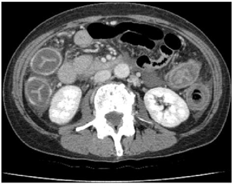 Contrast-enhanced CT scan at the level of the kidney showing wall ...