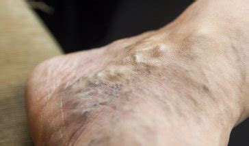 Swollen Veins: What Causes Them and What Can Treat Them