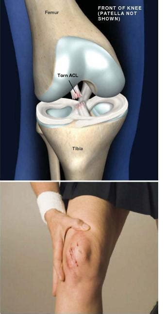 Anterior Cruciate Ligament Tear (ACL Tear) - Sarasota, FL: Schofield, Hand and Bright Orthopaedics