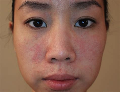 Allergic Reaction Skin Rash Treatment - vrogue.co