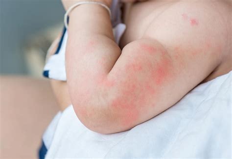 Baby Hives: Causes, Signs, Diagnosis and Prevention