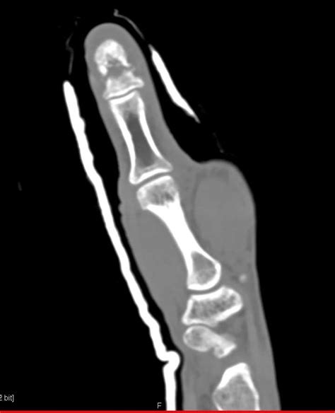 Fracture Distal Phalanx 1st Digit - Trauma Case Studies - CTisus CT Scanning