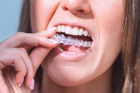 Invisalign treatment Coral Gables