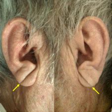 A diagonal earlobe crease - European Journal of Internal Medicine