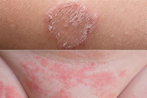 Fungal Rash On Skin