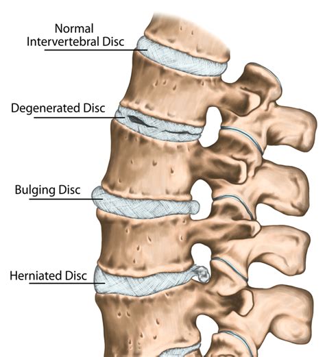 Disc Bulge/Herniation | Portland Physical Therapy