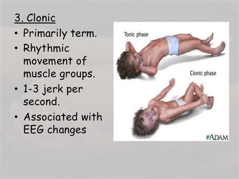 Neonatal seizures