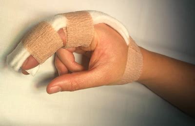 Distal Phalanx Fracture Splint