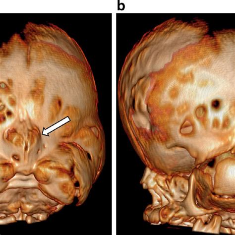 -Three-dimensional reformatted image of the CT in Fig. 1 viewed from... | Download Scientific ...