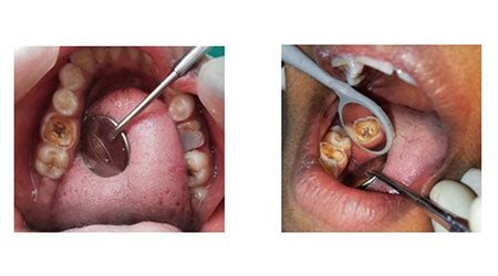 G–technique: An effective and precise method for rapid Derotation of teeth