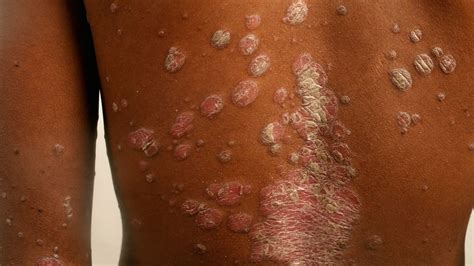 8 Types of Psoriasis: Photos, Symptoms, and More