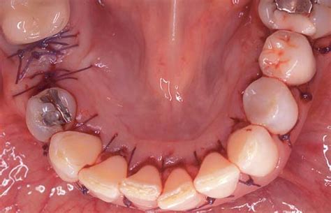 Mandibular Torus – Dental space