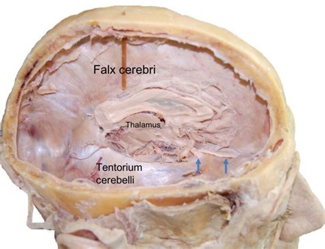 The Tentorium Cerebelli: A Comprehensive Review Including Its Anatomy, Embryology, and Surgical ...