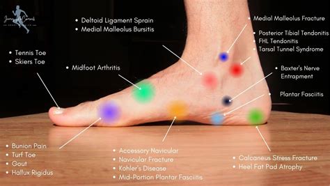 Foot Pain Chart: Top of Foot, Side and Front of Foot Pain Chart