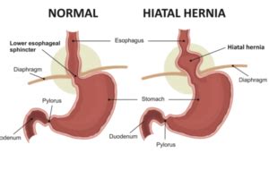 What is a Hiatal Hernia? Types, Symptoms, Causes, Diagnosis (Updated on October 2023)