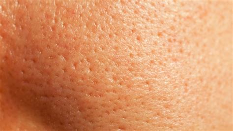 Was sind Poren? Wie man große Poren loswird: 3 Wege