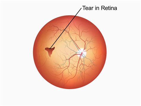 How Do I Know If I Have a Torn or Detached Retina? | Retina Associates ...