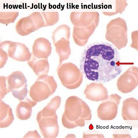 Howell-Jolly bodies in neutrophils - Blood Academy