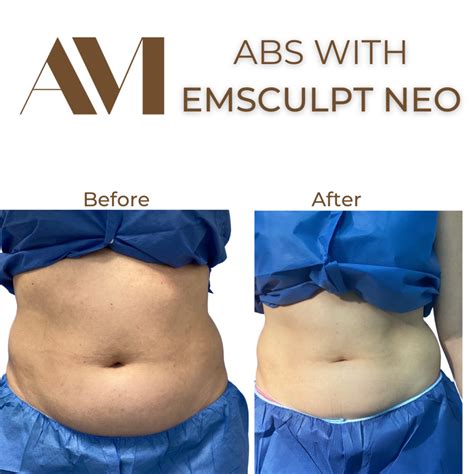 Before & After EMSculpt Neo Miami Beach | Dr. Alonso Martin MD