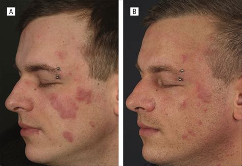 Systemic Lupus Erythematosus Rash